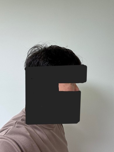 after photo: 눈밑지방재배치