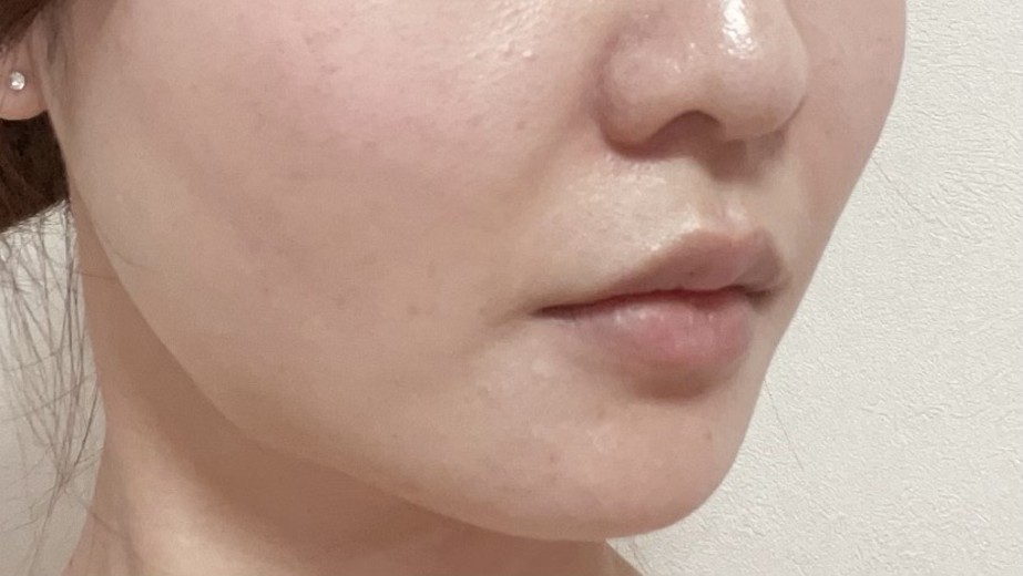 before photo: ダーマペン