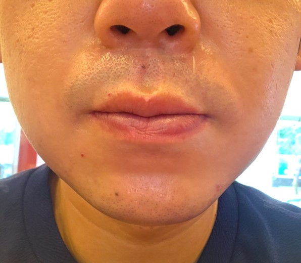 after photo: 아쿠아필링, 수염제모