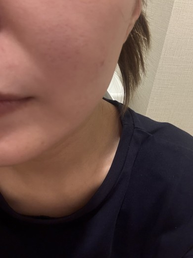 after photo: マッサージピール(コラーゲンピール)