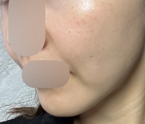 before photo: Qスイッチレーザー