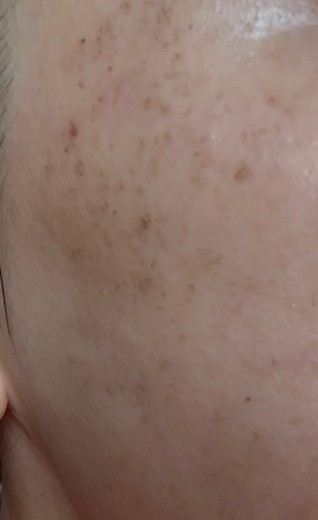 after photo: エレクトロポレーション, ルメッカ