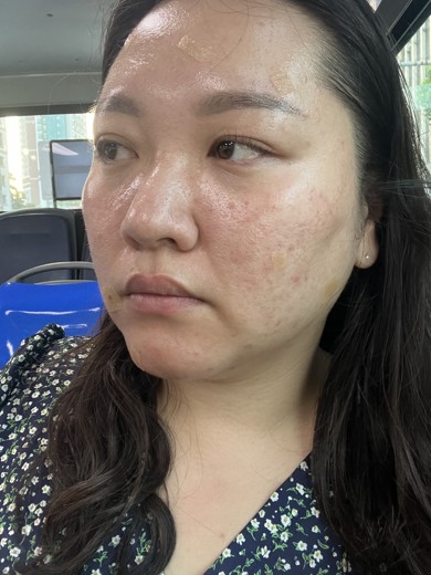 after photo: 점제거시술, V레이저