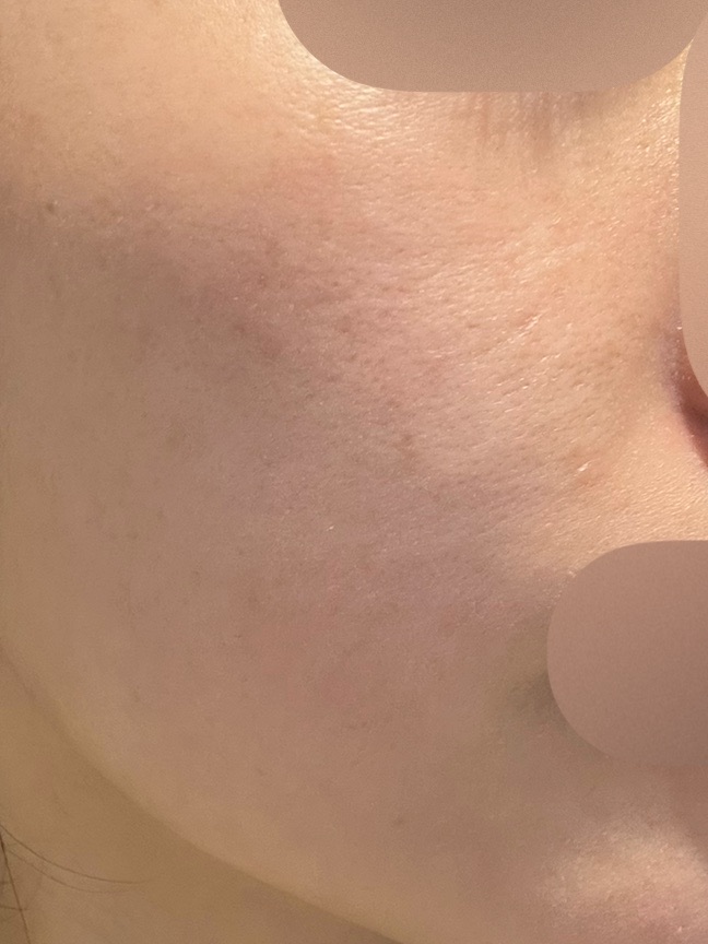 ララピール＋エレクトロポレーション（全顔＋首・1回）【再来OK