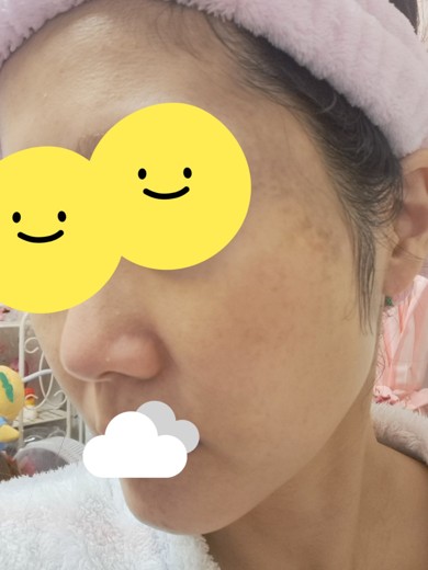 after photo: ピーリング, エレクトロポレーション, ルメッカ