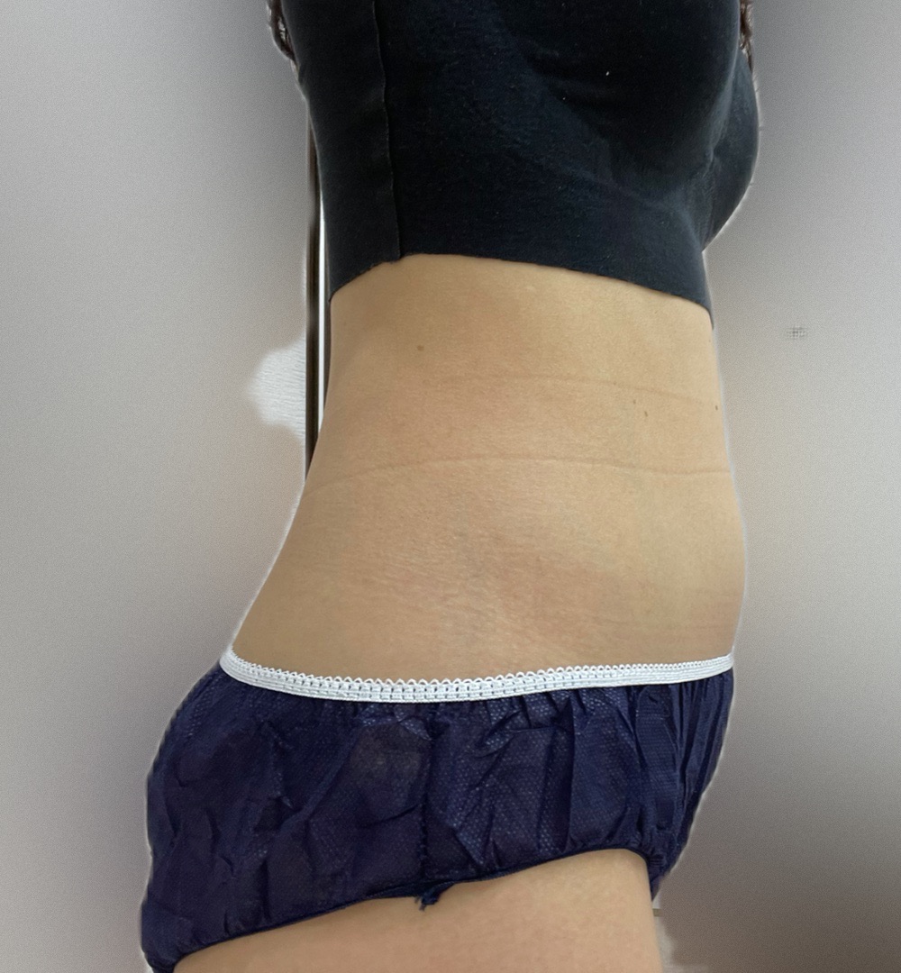 脂肪冷却 顎、二の腕用ハンドル 脂肪冷却 顎、二の腕用ハンドル 脂肪