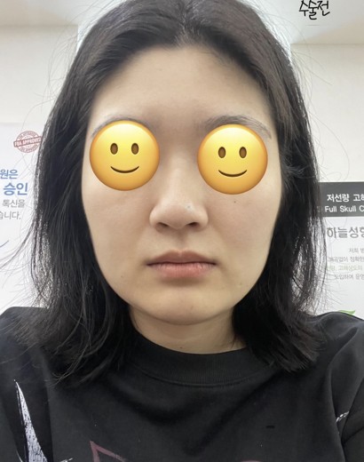 before photo: 콧대(보형물), 코끝(자가연골)