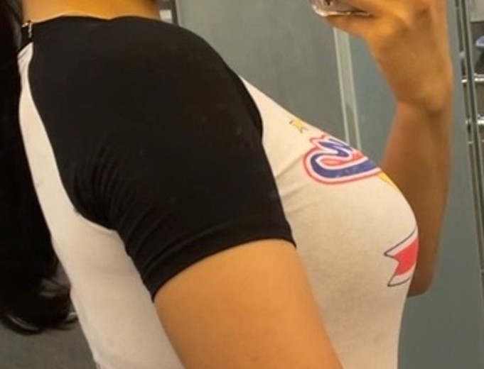 before photo: 가슴보형물제거