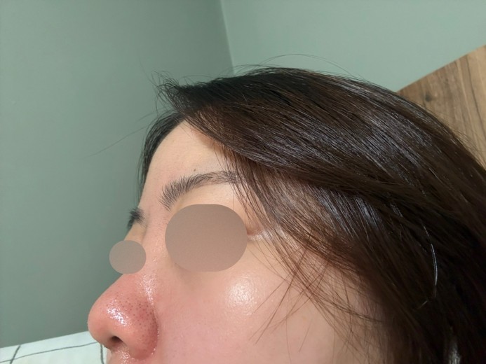 after photo: 콧대(보형물), 코끝(자가연골), 복코교정(수술)