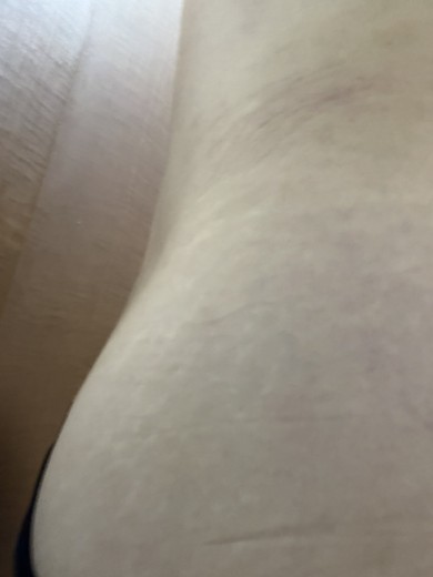 before photo: 脂肪冷却(脇腹), 脂肪冷却(お尻)