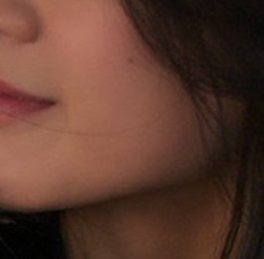 after photo: 온다리프팅