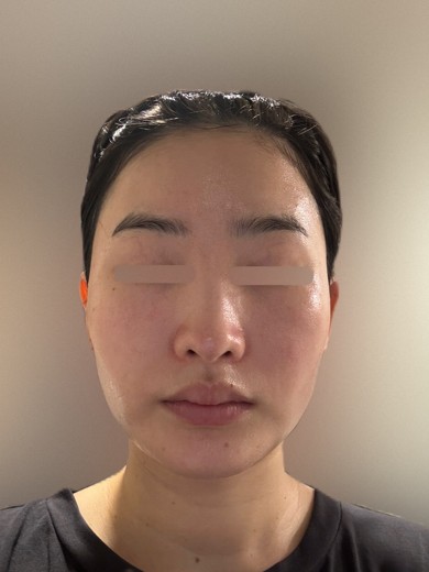 after photo: エレクトロポレーション