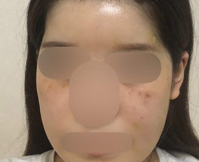 after photo: リジュランヒーラー, スキンボトックス