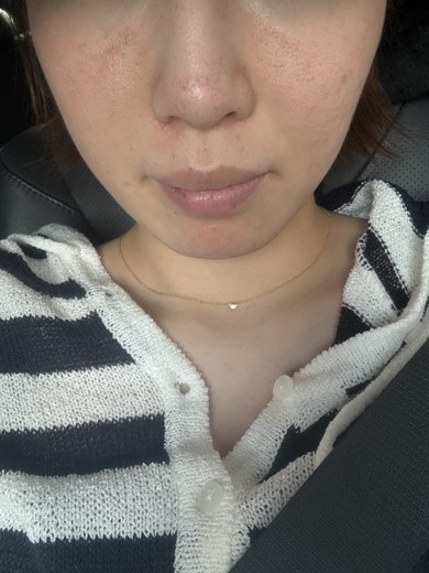 after photo: ダーマペン