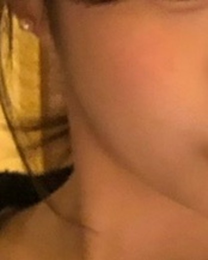 after photo: 윤곽주사