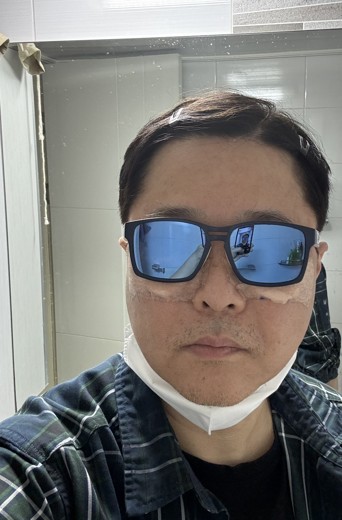 after photo: 눈밑지방재배치