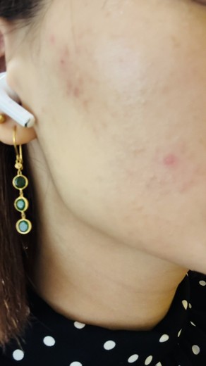 before photo: IPL(光/フォト治療), ピーリング, エレクトロポレーション