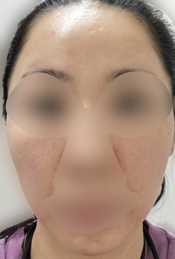after photo: ルメッカ