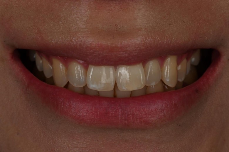 before photo: 라미네이트