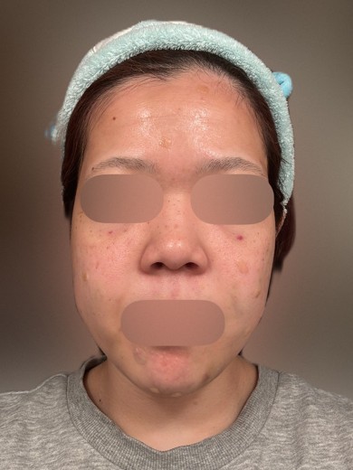 after photo: フラクショナルレーザー, レーザートーニング, ほくろ除去(レーザー)