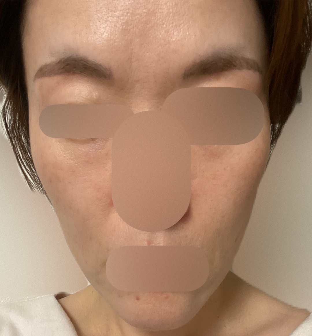 アクアピール＋エレクトロポレーション【薬剤代込】【再来OK