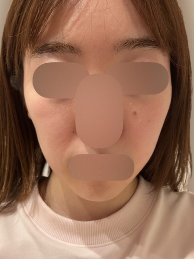 after photo: ルメッカ