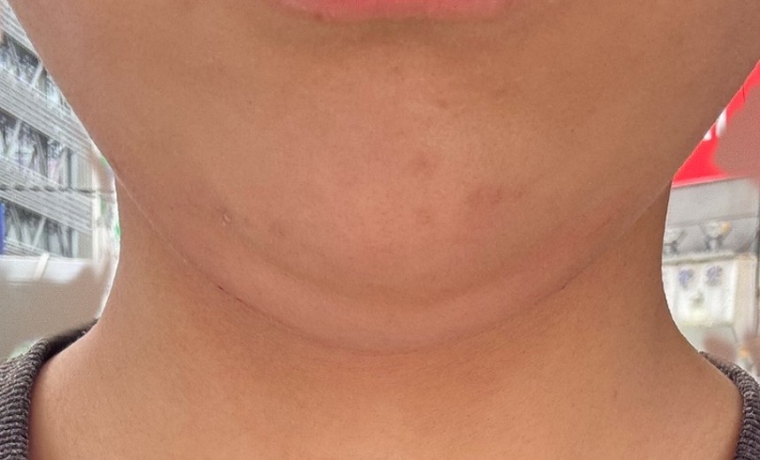 after photo: 脂肪溶解注射(顔)