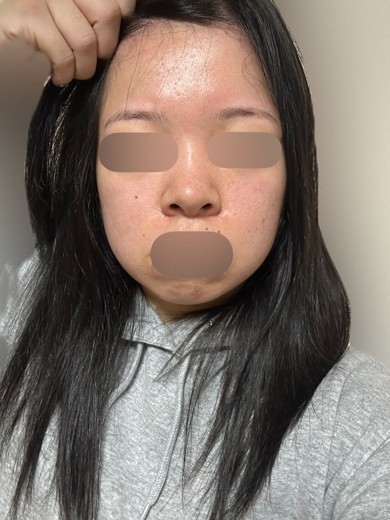 before photo: ダーマペン