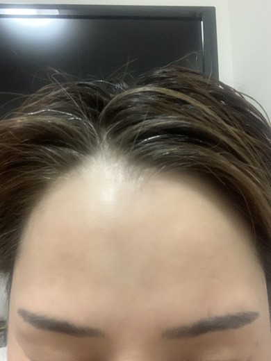 after photo: ピーリング, ルメッカ