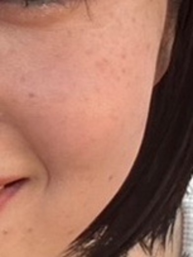 before photo: IPL(光/フォト治療)
