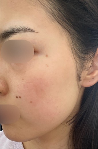 before photo: エレクトロポレーション