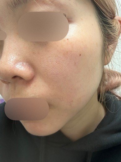 before photo: IPL(光/フォト治療)