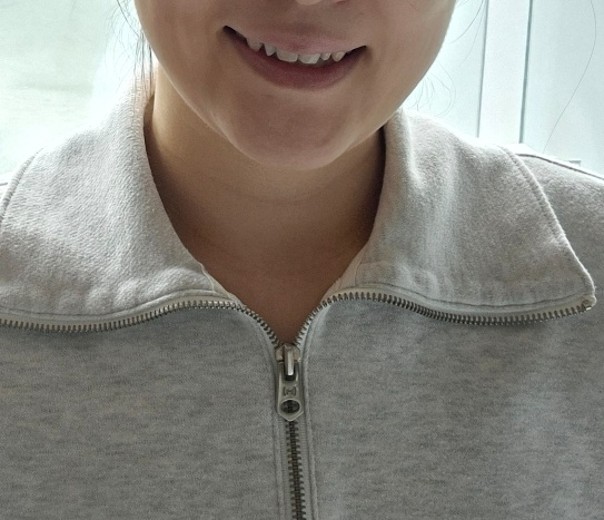 before photo: 입술필러