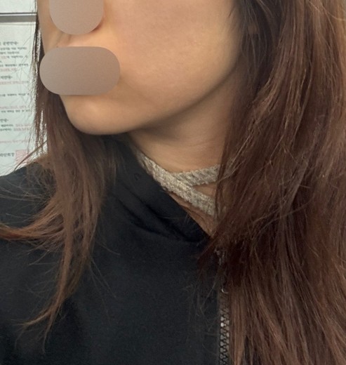 before photo: 턱끝필러