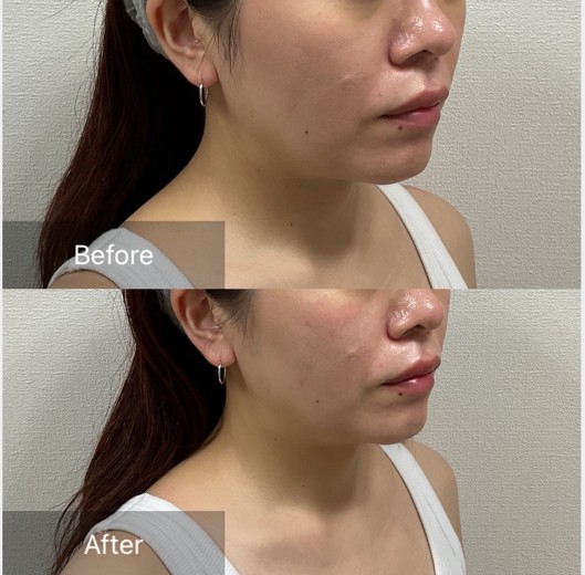 before photo: ピーリング, チタニウムリフト