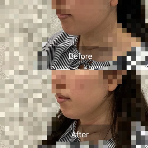 before photo: チタニウムリフト