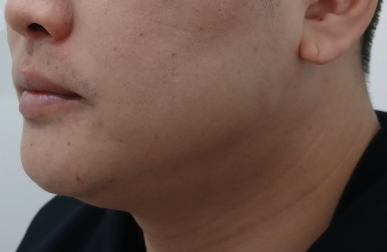 before photo: 울쎄라리프팅