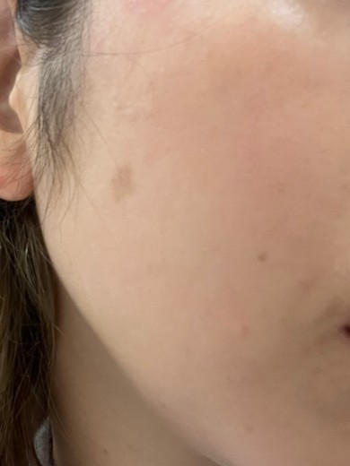before photo: エレクトロポレーション