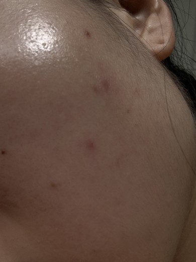 after photo: 스킨스케일링, 여드름압출