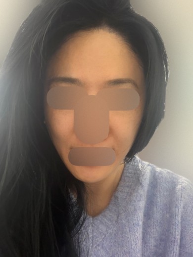 after photo: 튠라이너