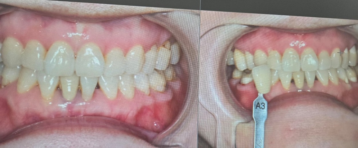 before photo: 치아미백