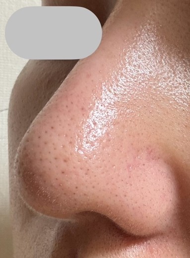 after photo: ハイドラジェントル