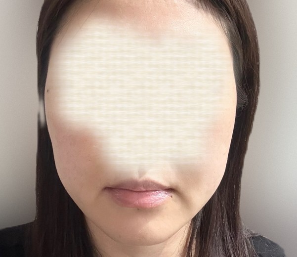 after photo: ボルニューマ