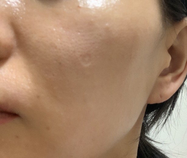 before photo: ピーリング, ルメッカ