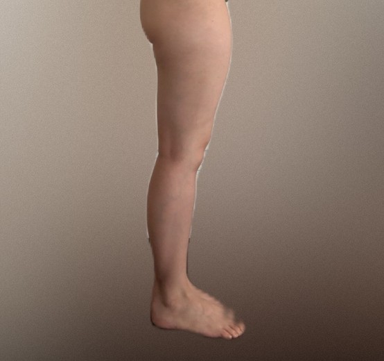 after photo: 脂肪溶解注射(太もも)