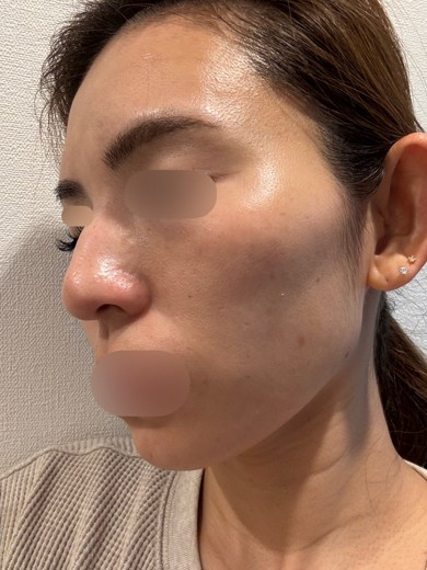 before photo: エクソソーム, ピコトーニング