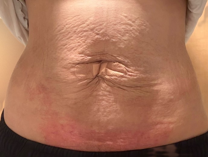 after photo: 脂肪吸引(腹部)
