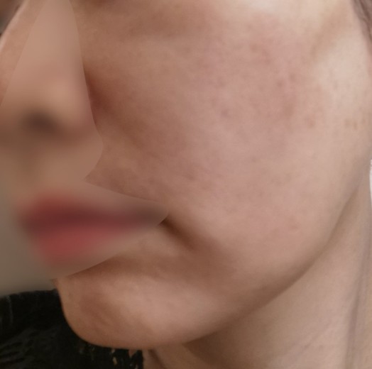 after photo: IPL(光/フォト治療)
