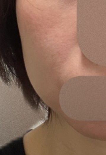 before photo: ボルニューマ
