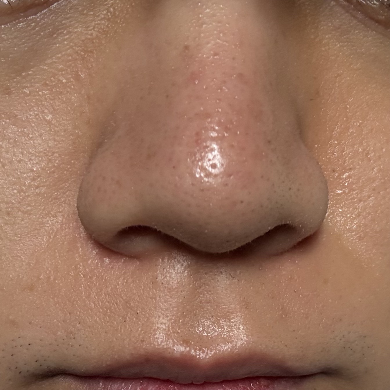 再来OK】ハイドラフェイシャル＋エレクトロポレーション